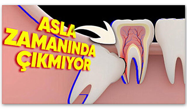 Yirmilik Dişlerin Genelde Yirmili Yaşlardan Sonra Çıkmasının Biraz Sinirinizi Bozacak Sebepleri