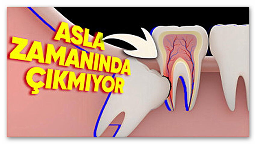 Yirmilik Dişlerin Genelde Yirmili Yaşlardan Sonra Çıkmasının Biraz Sinirinizi Bozacak Sebepleri