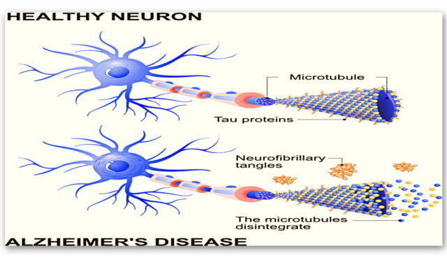 Tek bir enzimi engellemenin, Alzheimer rahatsızlığının etkilerini geri çevirmekte büyük avantaj sağlayabilir.