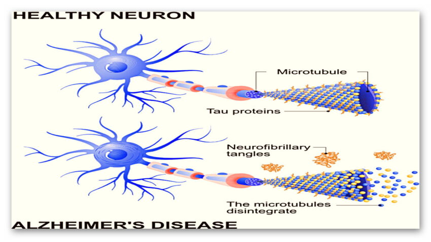 Tek bir enzimi engellemenin, Alzheimer rahatsızlığının etkilerini geri çevirmekte büyük avantaj sağlayabilir.