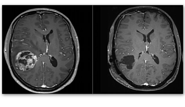 En Ölümcül Beyin Kanseri Türlerinden Birinin Tedavisinde Yeni Umut