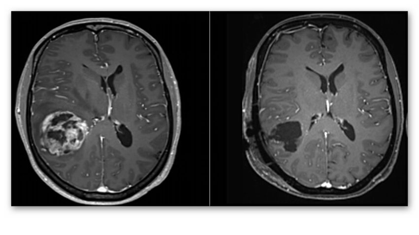 En Ölümcül Beyin Kanseri Türlerinden Birinin Tedavisinde Yeni Umut